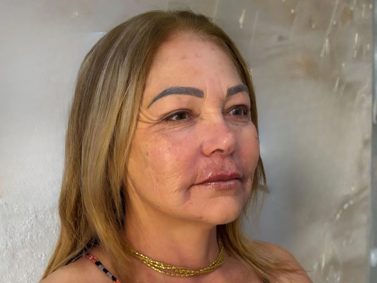 Depois Protocolo Elleve